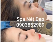 Spa Tiêm Filler Uy Tín Quận 6